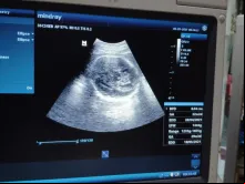 Monitor mostra os resultados de um exame de ultrassom